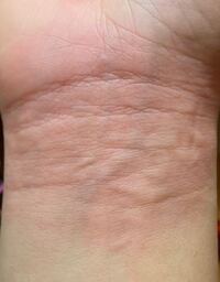 手首 かゆい ぶつぶつ 3468 手首 かゆい ぶつぶつ