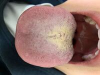 舌磨きをしても真ん中の舌苔が取れません 息も臭いです 舌から匂います Yahoo 知恵袋