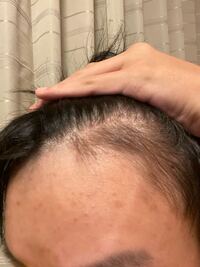 中学3年でこれははげてますよね 対策などあれば教えて下さい 写 Yahoo 知恵袋