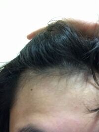 歳なんですが最近おでこ広く気になったんですがこの生え際はハゲてますか 昔 Yahoo 知恵袋