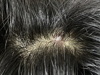 頭皮にあるこの白いニキビのようなものは何なのでしょうか 痛くも痒くもありませ Yahoo 知恵袋