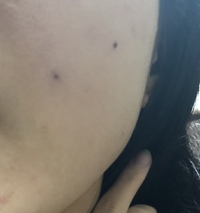 頬にホクロのような黒いニキビのようなものが出来てしまいました しこりが Yahoo 知恵袋