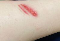 閲覧注意 1週間前にヘアアイロンで足を火傷しま Yahoo 知恵袋