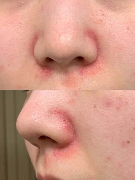 皮膚の病気 アトピー 解決済みの質問 Yahoo 知恵袋