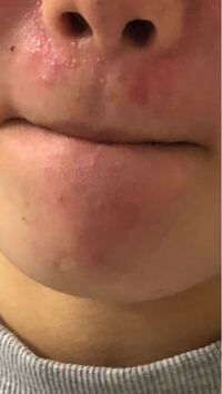 閲覧注意 私は鼻の下のニキビと顎のニキビに困ってます 睡眠は Yahoo 知恵袋