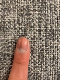 自分爪に黒い線があってネットで調べたら がんや内出血と書いていて心 Yahoo 知恵袋