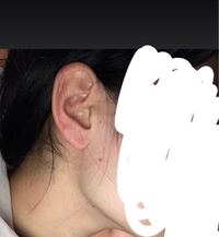 過食嘔吐 カショオの方でエラボトックスを受けられた方みえます Yahoo 知恵袋