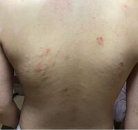 背中にこんな湿疹ができてるんですけど これはダニですかね Yahoo 知恵袋