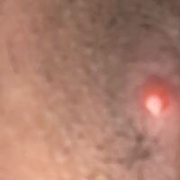 女性です 性器にこのような出来物が出来ました これはなんなのでしょうか Yahoo 知恵袋