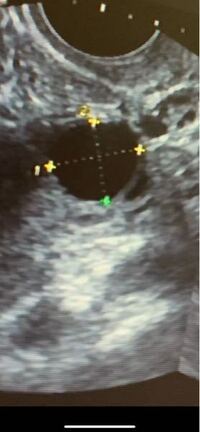卵胞チェックに行き前回12mm 今回育ってて良かったあ 15 8mm Yahoo 知恵袋