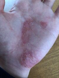 手荒れについて困っています 小さい頃からアトピーのような症状でよく手に出てい Yahoo 知恵袋