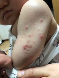 質問失礼します 1歳半年の娘の腕にこのようなニキビのようなものが増 Yahoo 知恵袋