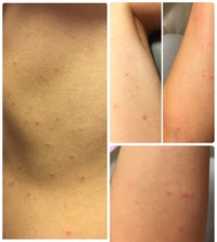 体に発疹が出来て 非常にかゆいのですがダニに刺されたのかまたは別の Yahoo 知恵袋