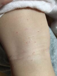 子供の左腕に 直径2ミリほどのイボ を見つけました 水疱瘡でもないよう Yahoo 知恵袋