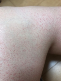 赤い点々 かゆくない 太もも 顔・腕・足・手・お腹・背中などのかゆくない湿疹の原因は？