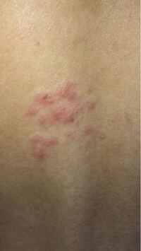 このブツブツ なんだと思いますか 昨日の朝起きると突然出来ていました Yahoo 知恵袋