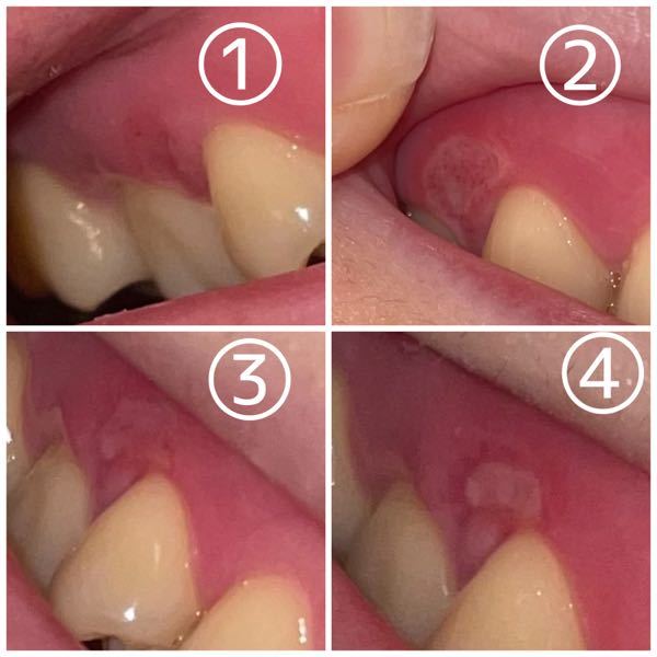 歯茎の口内炎について 約2週間前 このときは少し違和感を感じる程度で歯ブラ Yahoo 知恵袋