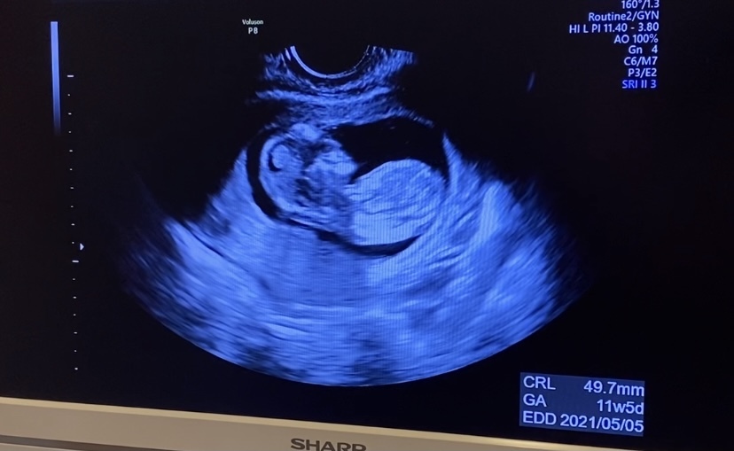 胎児のnt何ミリに見えますか 妊娠12週ごろのエコーです 私のと比較し Yahoo 知恵袋