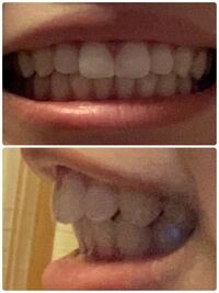 私の歯は出っ歯に入りますか Yahoo 知恵袋