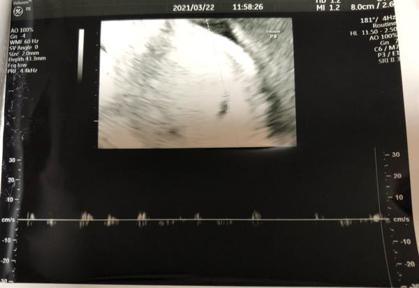 エコー写真の見方について教えて頂けますと幸いです 胎嚢の確認 Yahoo 知恵袋