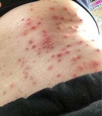 お腹と太ももの片側にのみ発疹ができ皮膚科2件いき 治らず2ヶ月血液検査しても Yahoo 知恵袋