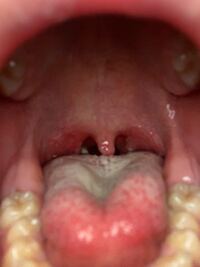 閲覧注意喉の痛み 扁桃腺 で悩んでます 4日ほど前から喉が痛く一昨日病院 Yahoo 知恵袋
