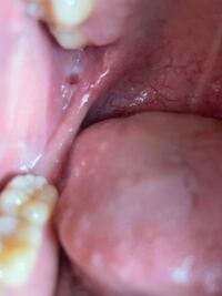 頬の裏に穴 ができて痛いです 現在歯医者に通っており銀歯の型 Yahoo 知恵袋