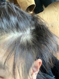 高校生です 写真のように頭皮が分け目などからとても透けて見え Yahoo 知恵袋