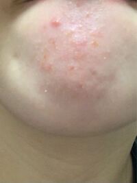 これ何かわかる人いますか ヘルペスですかね 泣 ヘルペスはなったことあり Yahoo 知恵袋