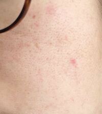 23歳女です 中学の頃からニキビ肌で現在も顔中にニキビ ニキビ跡が Yahoo 知恵袋