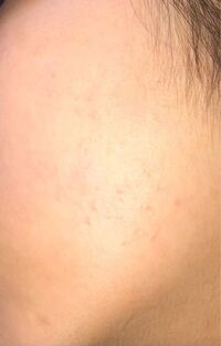 このブツブツはなんですか フェイスラインの上あたりに出来ていて治り Yahoo 知恵袋