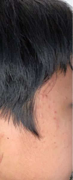 これはニキビですか ニキビみたいに膿か溜まってる感じなないのでニキビに Yahoo 知恵袋