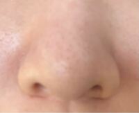 鼻を細くする方法 私の鼻は写真のように鼻筋が通っていなく大き Yahoo 知恵袋