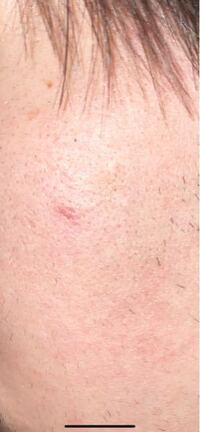 このニキビ跡を消すため 病院に行きます ケミカルピーリングや Yahoo 知恵袋