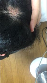 頭皮の赤い所を広げた写真なんですけど早いめに診てもらった方が良いですか Yahoo 知恵袋