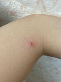 内出血のようなものができて一年ほど経ちますか治りません いたくもか Yahoo 知恵袋