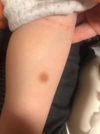 保育園に通ってる3歳の子供の背中に今日3箇所目立つ青あざがあ Yahoo 知恵袋