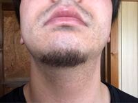 髭脱毛について この髭は濃い方ですか 医療脱毛するとしたら何回程でなく Yahoo 知恵袋