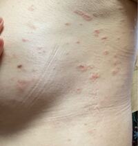 汚い写真ですいません 一昨日くらいから主に胸の横 脇あたりに Yahoo 知恵袋