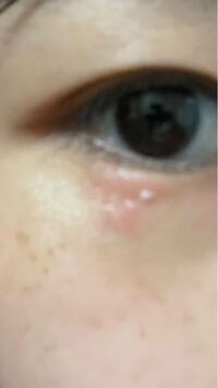 これってかぶれでしょうか 朝起きたらなってました 記憶にあるのは 漂白 Yahoo 知恵袋