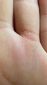 左手の薬指のこの荒れがなかなか治らず 皮膚科に行けば良くなるでしょうか Yahoo 知恵袋