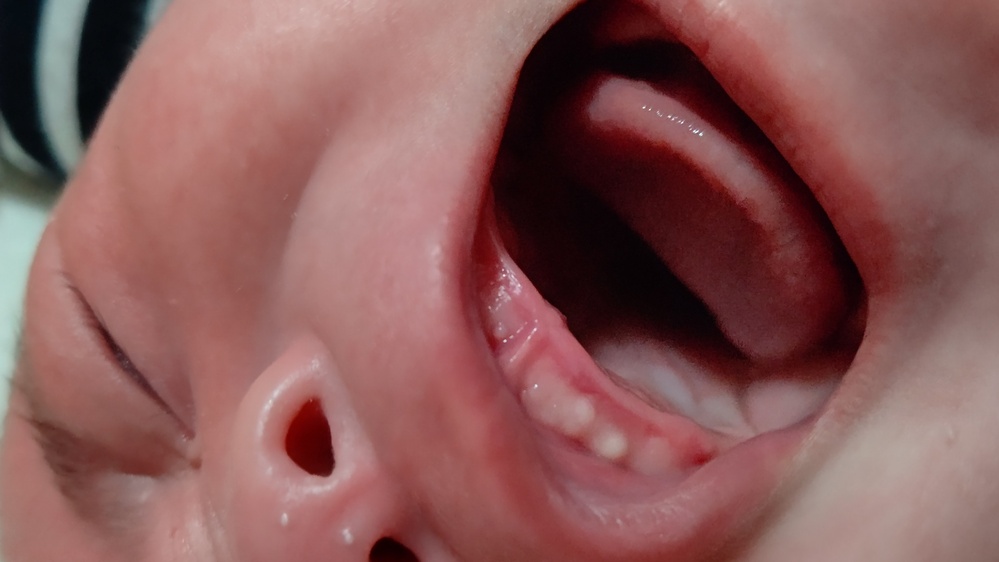 ４ヶ月の赤ちゃんの口にできているのは口内炎でしょうか 上の左歯茎二個 右に一 Yahoo 知恵袋