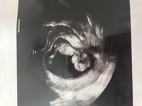 生後1日目になる娘がダウン症じゃないか不安です いとこ婚をして出産 Yahoo 知恵袋