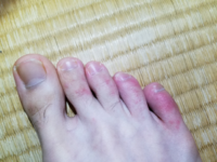 １週間前くらいから足の指が猛烈に痒いです 普段から清潔にしてるので水虫ではな Yahoo 知恵袋