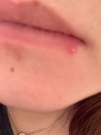 口のところにできてて痛いです これはニキビでしょうか ニキビかと Yahoo 知恵袋