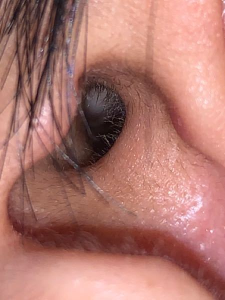 耳かきのしすぎなのか もう片方の耳と違って鼓膜 みたいなのが見えます 画像の Yahoo 知恵袋