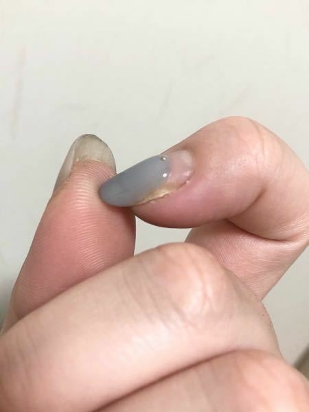 スカルプネイルによる深爪矯正をしようと考えています 今まで Yahoo 知恵袋