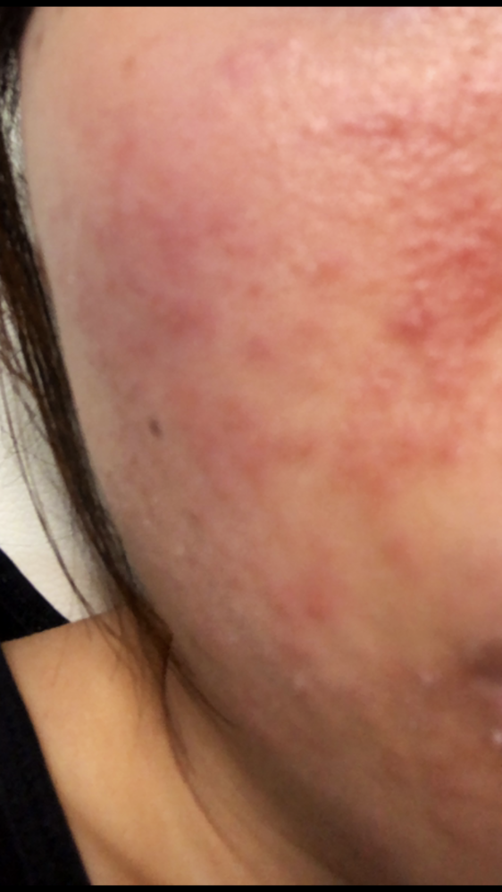 皮膚の病気 アトピー 回答受付中の質問 Yahoo 知恵袋