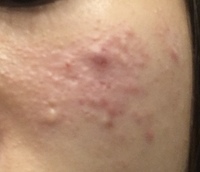 閲覧注意 さっき ついつい気になって 頬のニキビを潰してしまいました 今 Yahoo 知恵袋