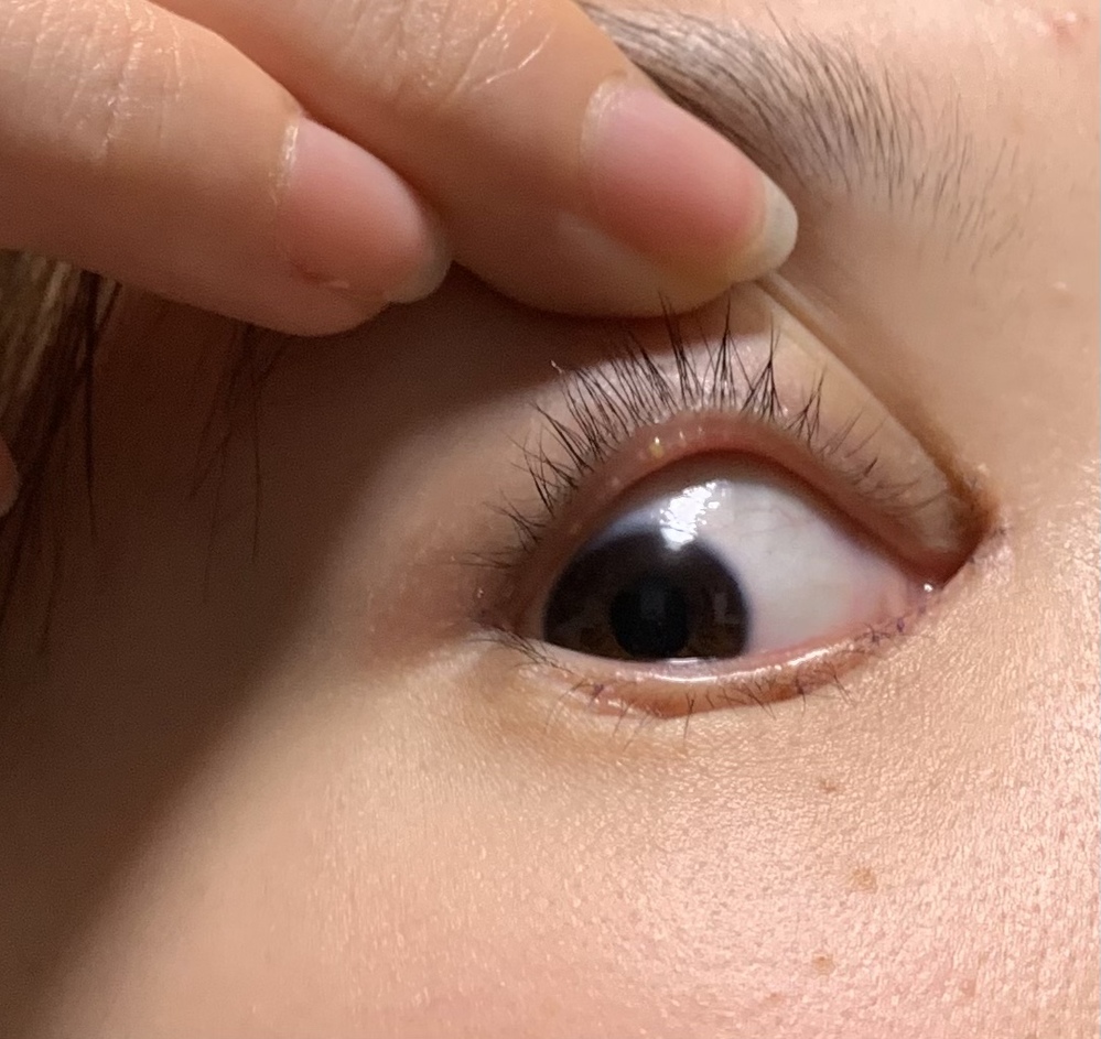 マイボーム腺の詰まり 画像あり痒くてまぶたの裏を見たら白いプツプツが沢山あ Yahoo 知恵袋